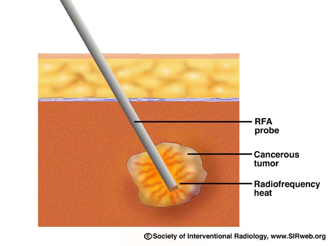 radiofrequency_ablation_2.jpg